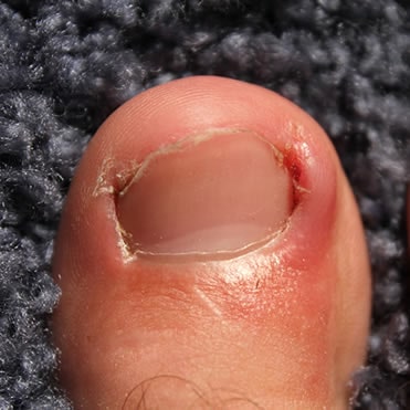 Ingrown Toenail