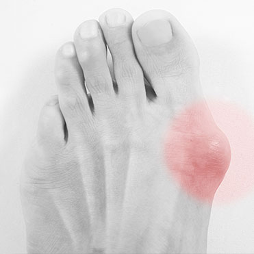 Lapiplasty® 3D Bunion Correction