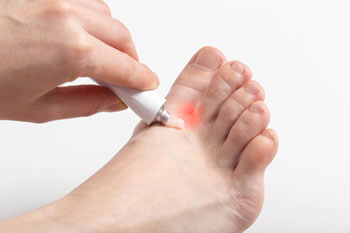 Athletes foot treatment in the Harris County, TX: Houston, Kingwood, Humble, Spring;  Atascosa County, TX: Atascocita; Montgomery County, TX: The Woodlands, Conroe, New Caney areas