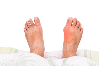 Bunions treatment and removal in the Chandler, AZ 85248 & Phoenix, AZ 85044 areas