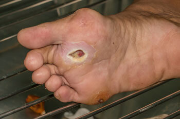 Diabetic foot treatment and care, Diabetic Ulcers Treatment & Management in the Chandler, AZ 85248 & Phoenix, AZ 85044 areas