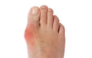 Gout Treatment in the Chandler, AZ 85248 & Phoenix, AZ 85044 areas