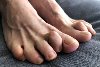 Hammertoes & Mallet Toes treatment in the Chandler, AZ 85248 & Phoenix, AZ 85044 areas