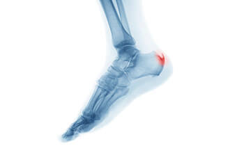 Heel spurs treatment in the Chandler, AZ 85248 & Phoenix, AZ 85044 areas