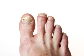 Fungal toenails, toenail fungus diagnosis and treatment in the Chandler, AZ 85248 & Phoenix, AZ 85044 areas