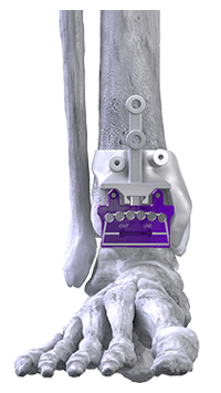 Total Ankle Replacement System in the Chandler, AZ 85248 & Phoenix, AZ 85044 areas