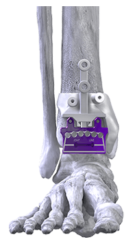 total ankle replacement