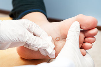 Plantar warts treatment in the Chandler, AZ 85248 & Phoenix, AZ 85044 areas
