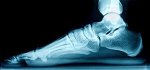 Flexible Flat Feet Is Common in Babies