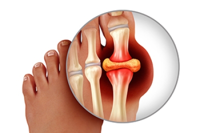 Managing Pain and Preventing Gout Flare-Ups