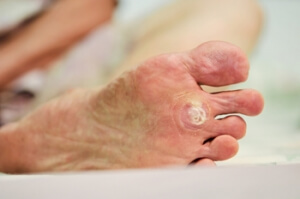 HPV Strains and Plantar Warts