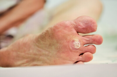 HPV Strains and Plantar Warts