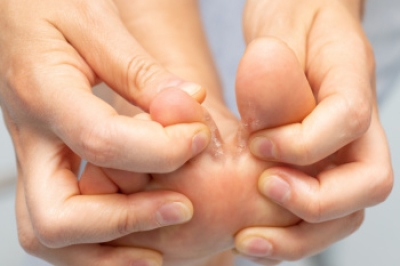 Athlete’s Foot and Its Causes