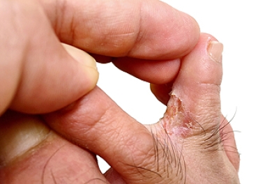 Athlete's Foot Is a Common but Treatable Skin Infection