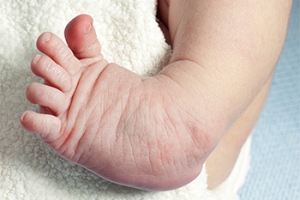 Surgery for Clubfoot Repair