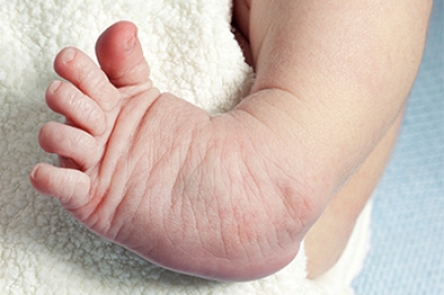 Surgery for Clubfoot Repair
