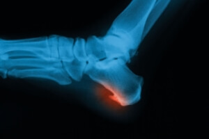 Facts About Cuboid Syndrome
