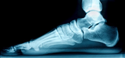 Different Types of Flat Feet