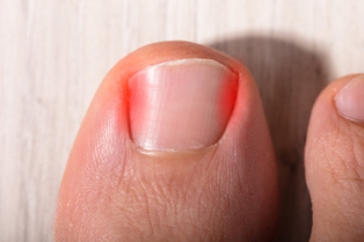 Ingrown Toenails and the Importance of Podiatric Care